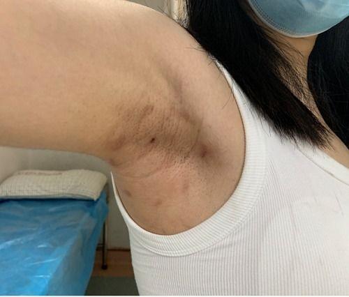 乳腺手术后可以吃小瓜吗,小瓜在恢复期的适宜摄入
